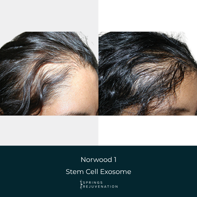 Before and After Results